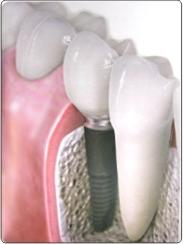 Процесс имплантации зубов 